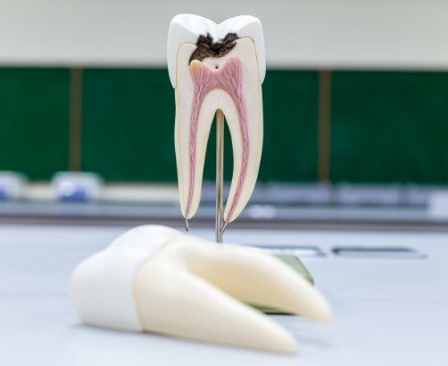 root canal