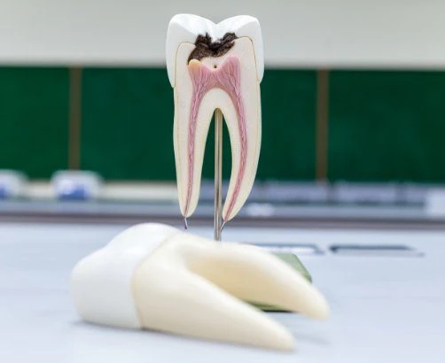 root canal