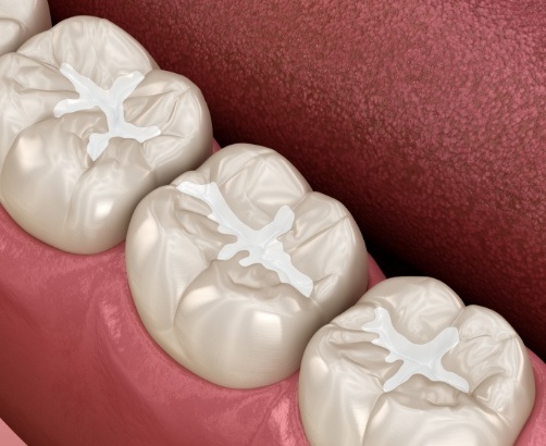 digital rendering of dental sealants