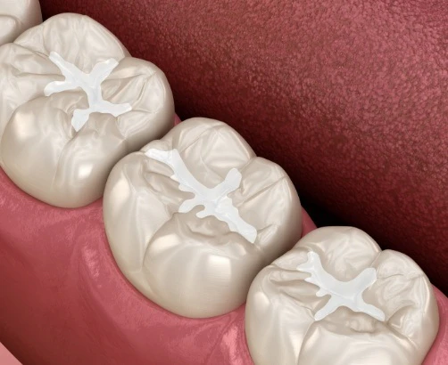 digital rendering of dental sealants