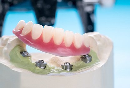 implant dentures