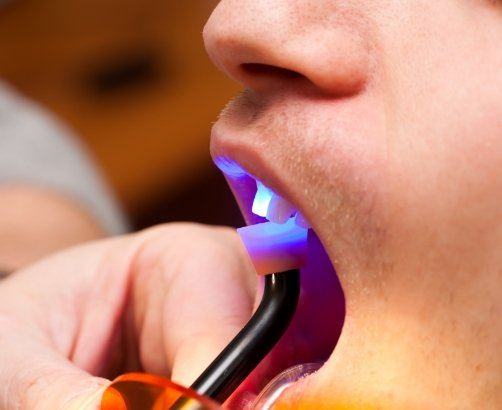 person getting dental bonding