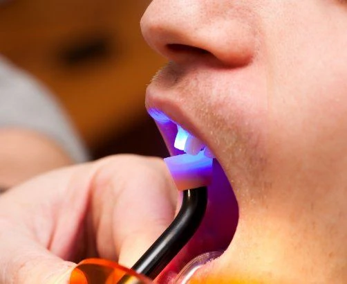 person getting dental bonding