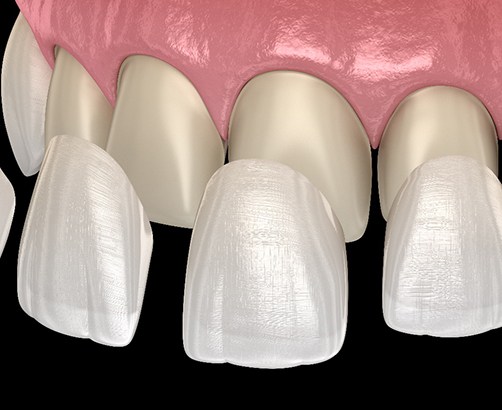 veneers getting on tooth