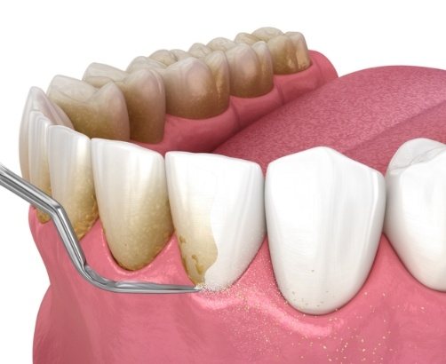 mouth with gum disease