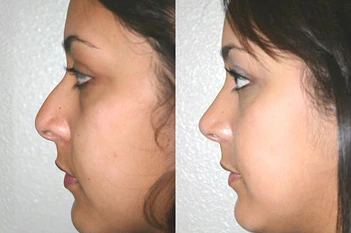 before rhinoplasty