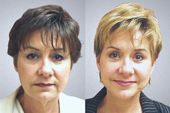 after rhinoplasty