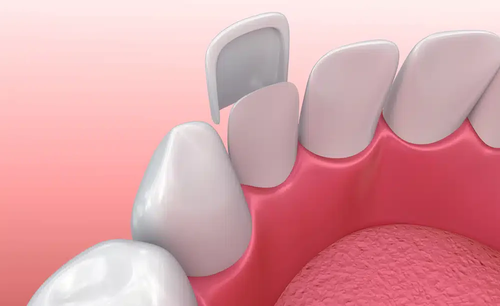 veneers model image