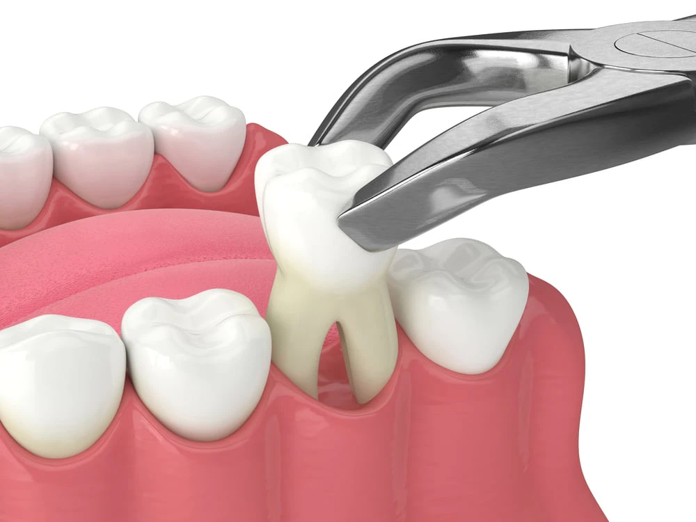 digital rendering of a tooth extraction