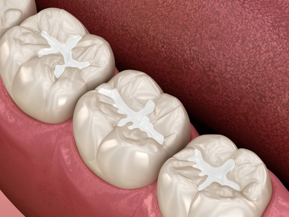 Digital rendering of sealants on molars