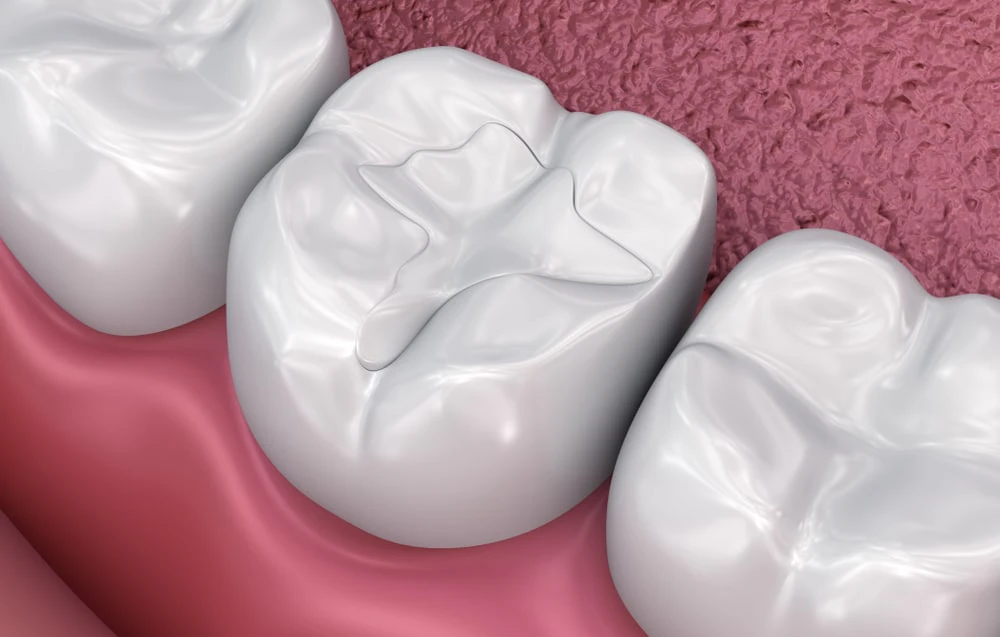 digital rendering of a composite filling in molar