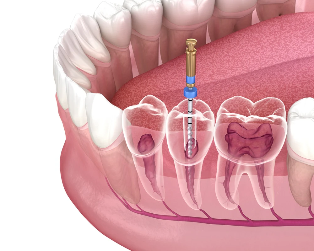 digital rendering of root canal process