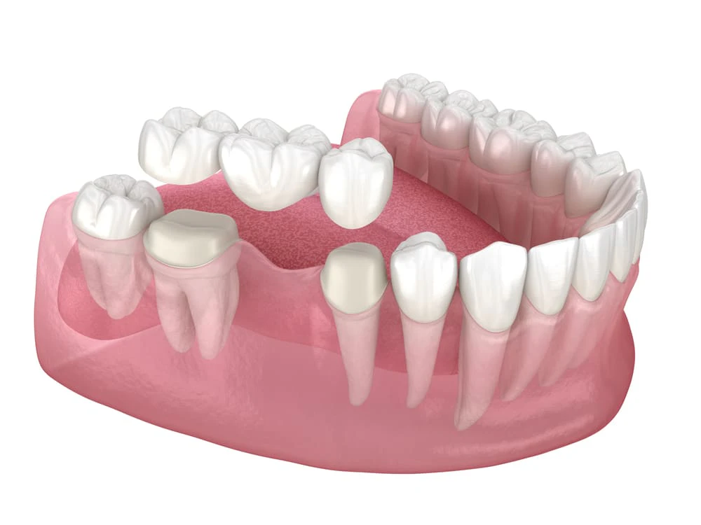 digital rendering of a dental bridge