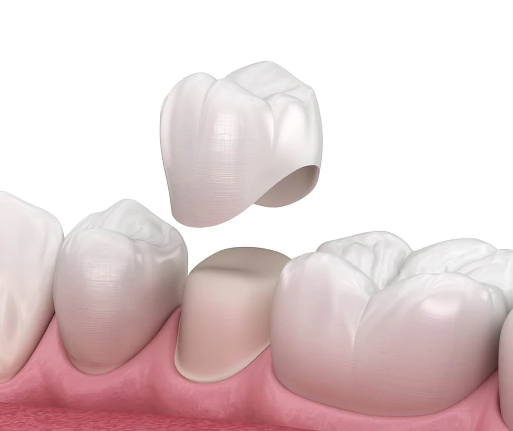 digital rendering of a dental crown
