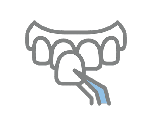 Veneers
