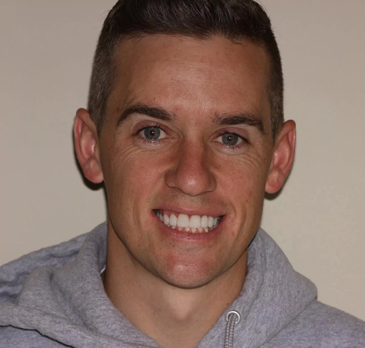 Before crowns and veneers