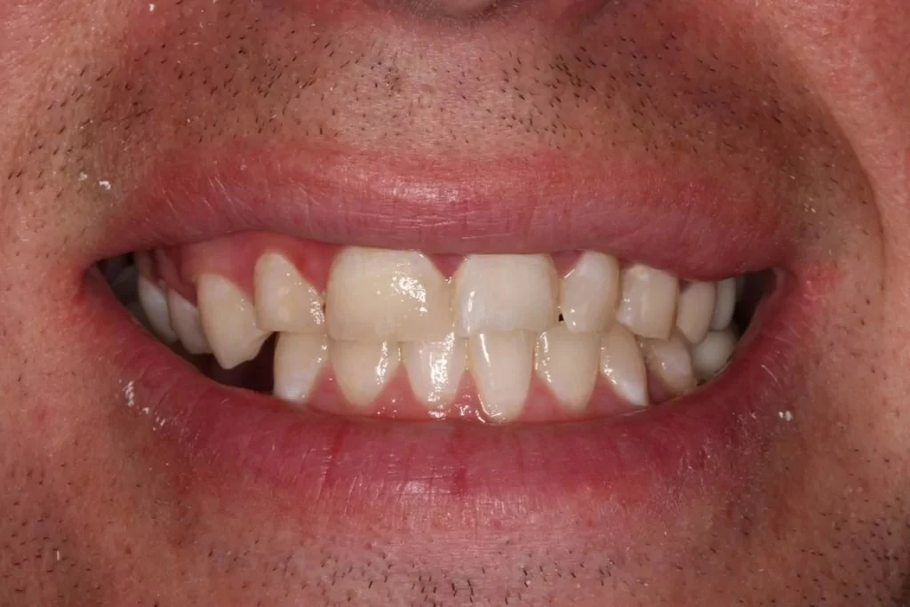 Before crowns and veneers