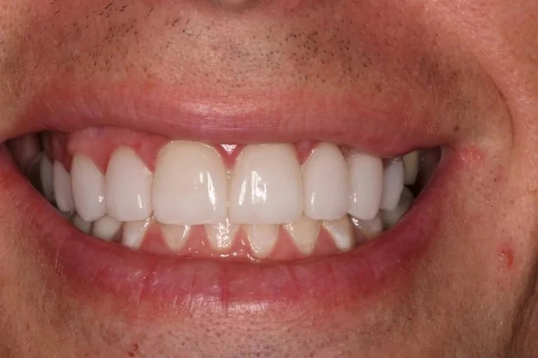 Before crowns and veneers