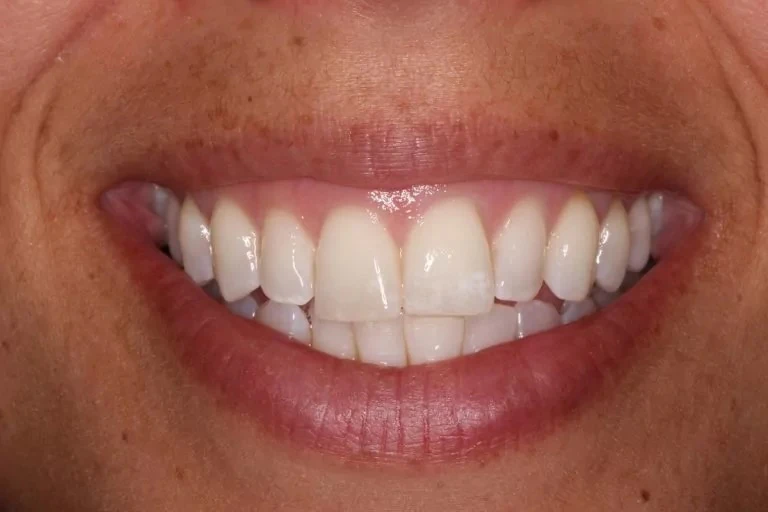 Patient before Invisalign