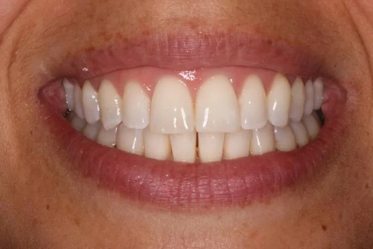 Patient after Invisalign