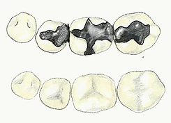 Silver versus white filling