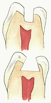 Fillings