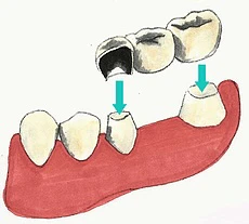 Dental bridge