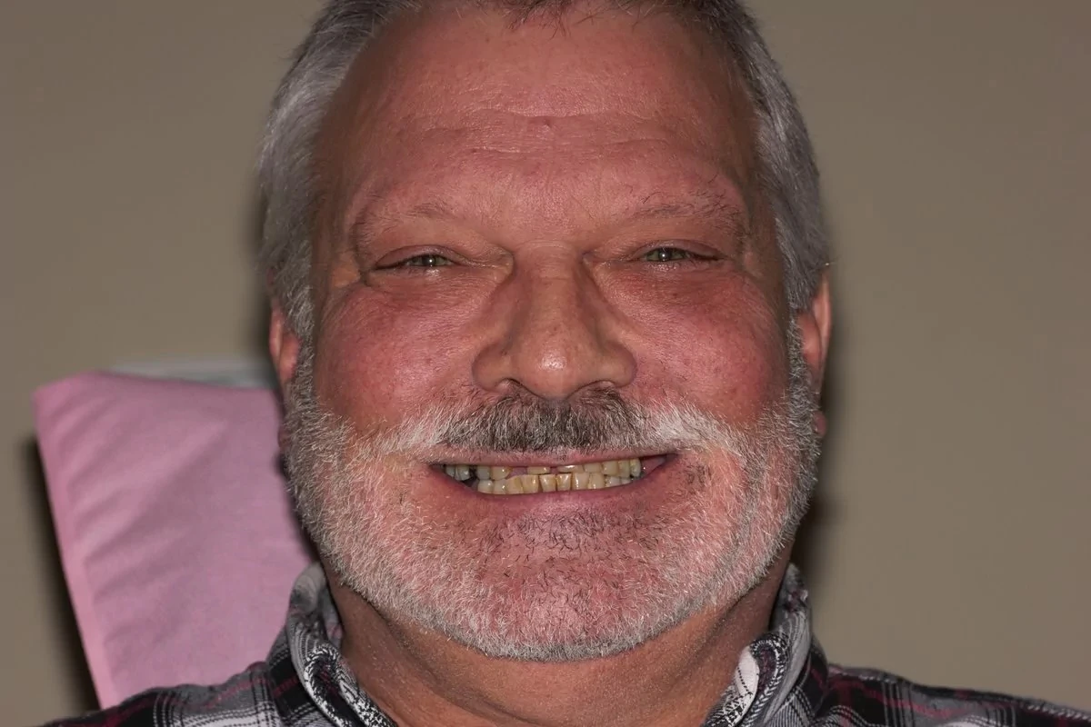 Before denture implants
