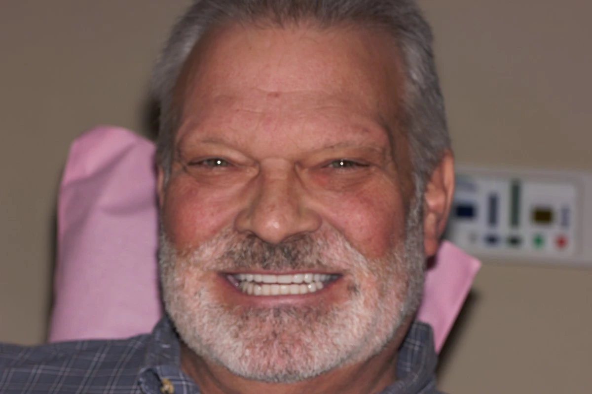After denture implants