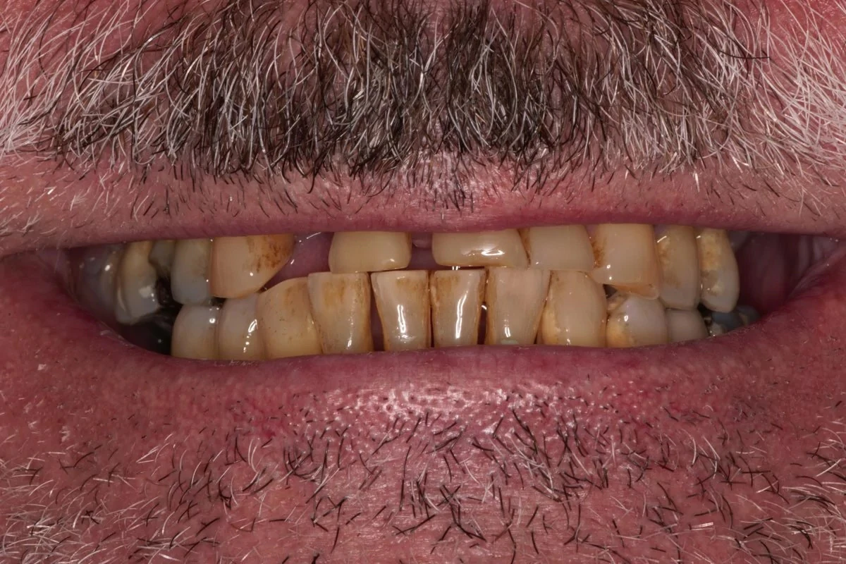 Before denture implants