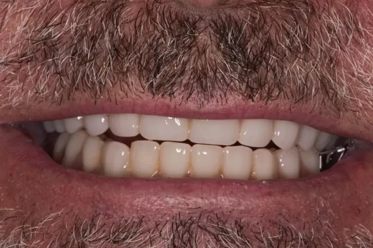 After denture implants