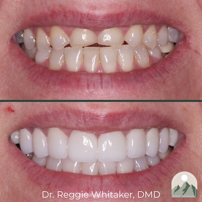 Before and After dental work