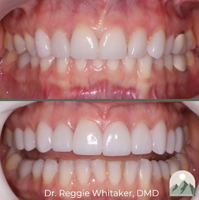 Before and After dental work