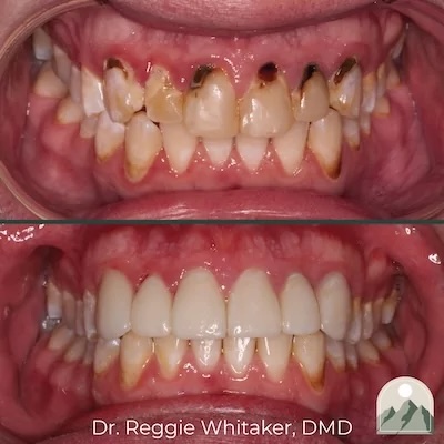 Before and After dental work