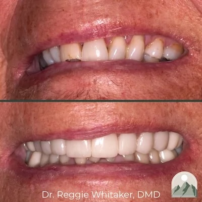 Before and After dental work
