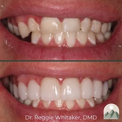 Before and After dental work