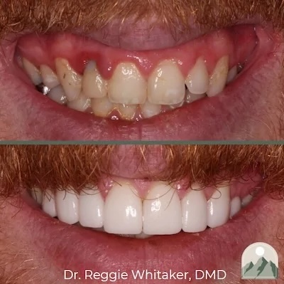 Before and After dental work
