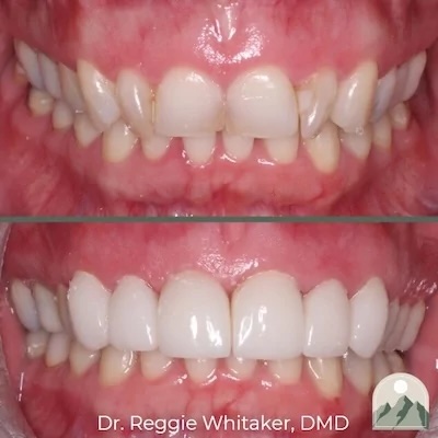 Before and After dental work
