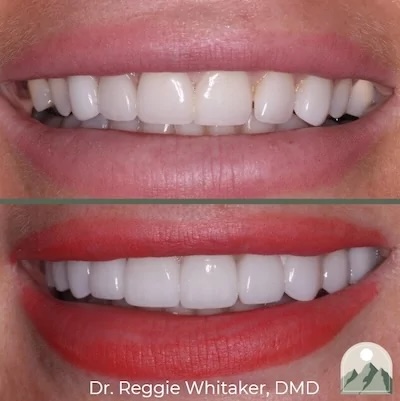 Before and After dental work