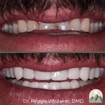 Before and After dental work