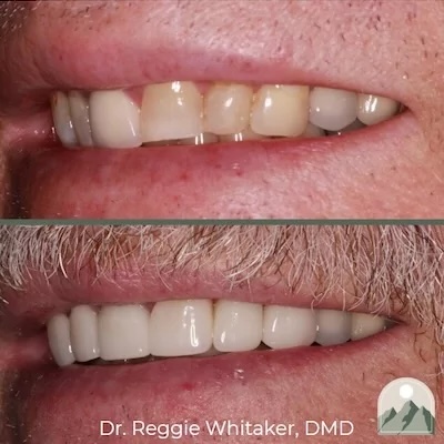 Before and After dental work