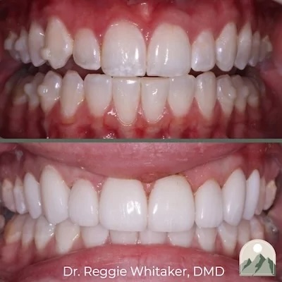 Before and After dental work