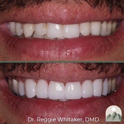 Before and After dental work