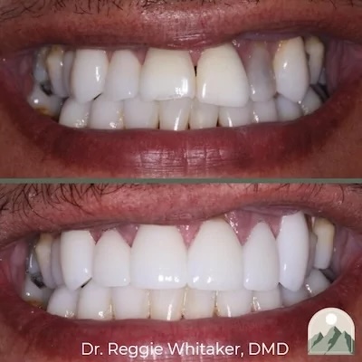 Before and After dental work