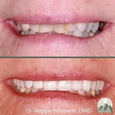 Before and After dental work