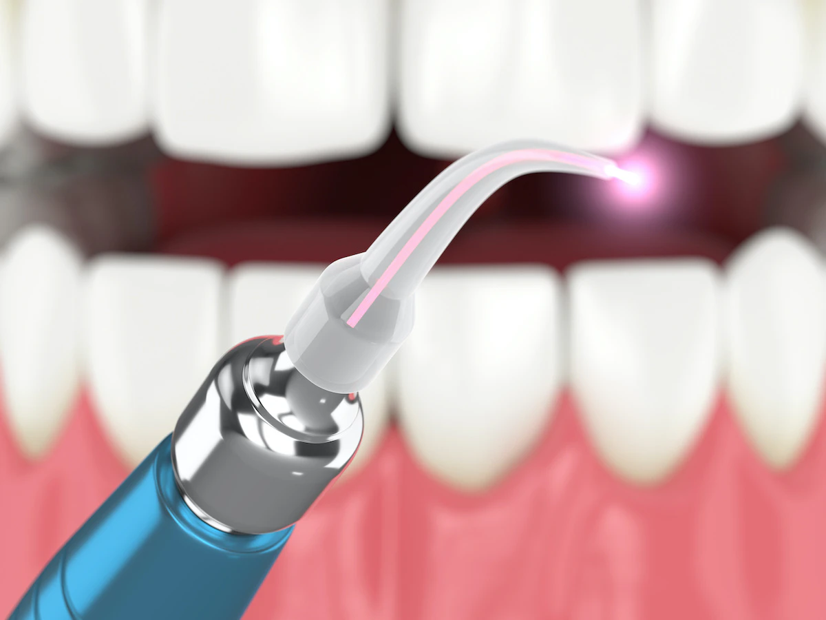 Laser dental tool