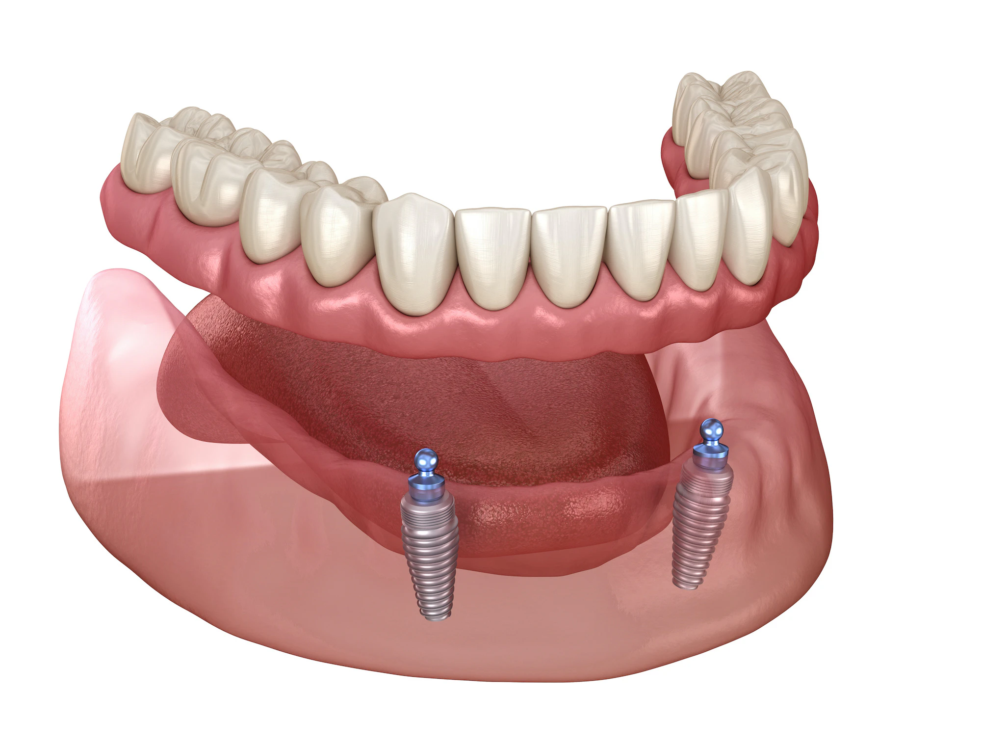 Implant-retained dentures