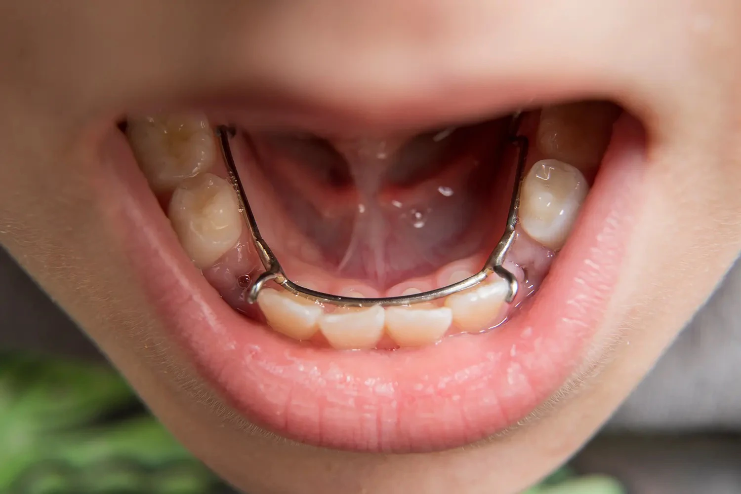 open mouth with bottom space maintainer