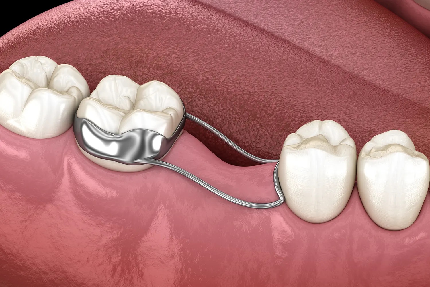digital rendering of dental spacer in mouth