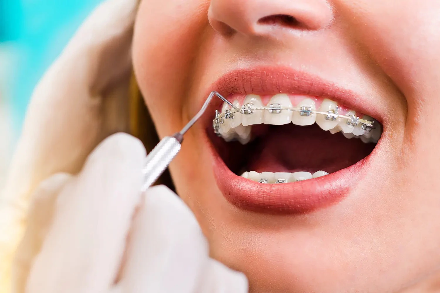 close up photo of woman with braces and dental tool